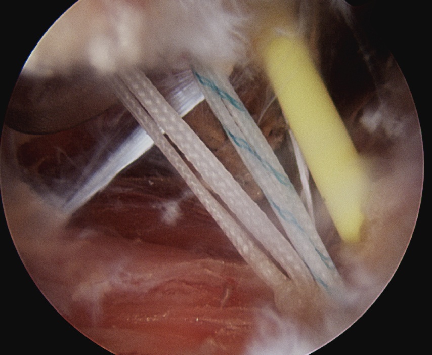 Remplissage Subacromial Space